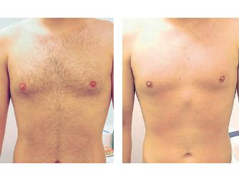 One Free Consultation + One Laser Hair Removal Treatment from CPW Vein & Aesthetic Center