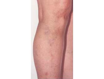 One Free Consultation + One Spider/Varicose Vein Treatment - CPW Vein & Aesthetic Center