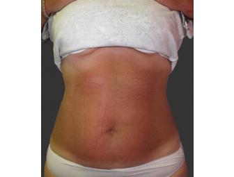 Exilis Tummy Treatment from Exhale Spa & Laser Center
