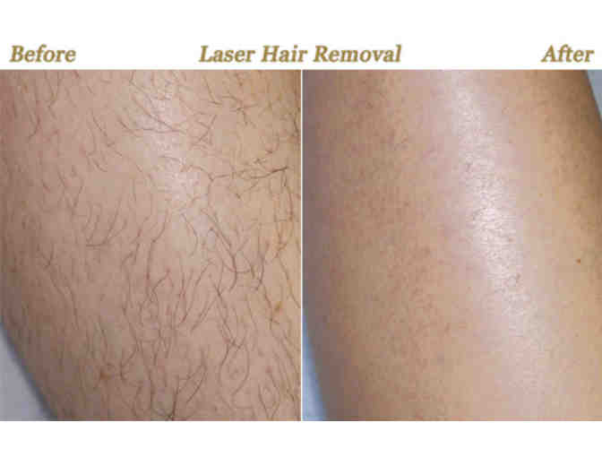 Body Rejuvenation | Cool Sculpt Fat Removal OR Laser Hair Removal OR 2 Peels OR Juvederm