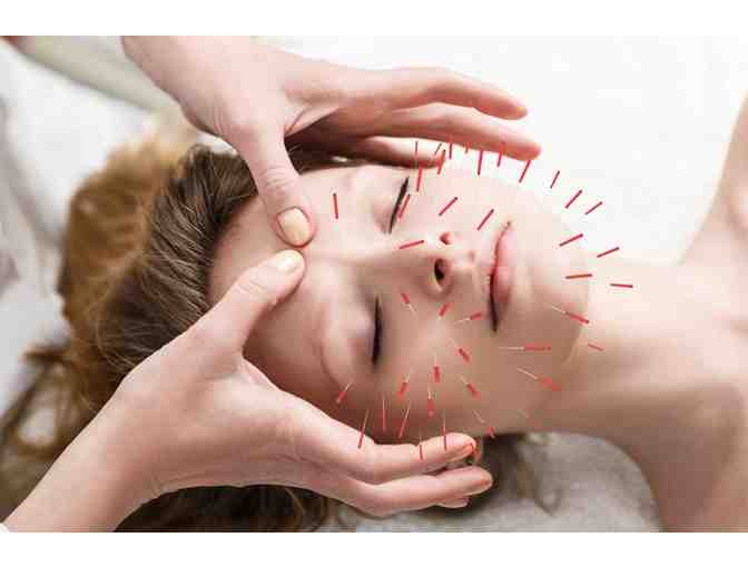 Universal Family Wellness Center - Acupuncture & Herbs Session