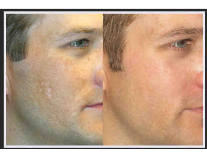 Pigment Treatment via Fotofacial from Surface Medical Spa