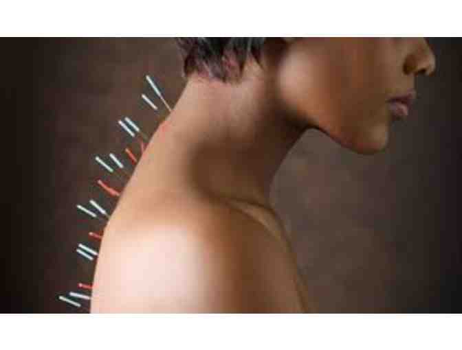Acupuncture Treatment Package