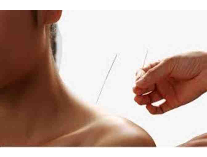 Acupuncture Wellness Treatment - Photo 1