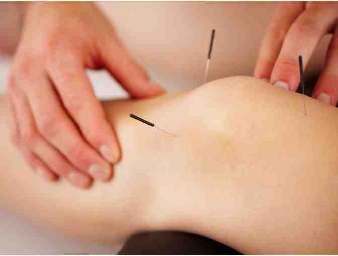Acupuncture or Shonishin Treatment with Alma Acupuncture - Adult or Child