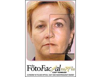 Fotofacial RF Skin Rejuvenation Treatmeant at RejuvaYou Medical Spas