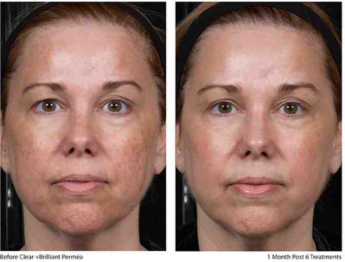 Clear and Brilliant Laser Treatment with Dr. Elizabeth Anderson