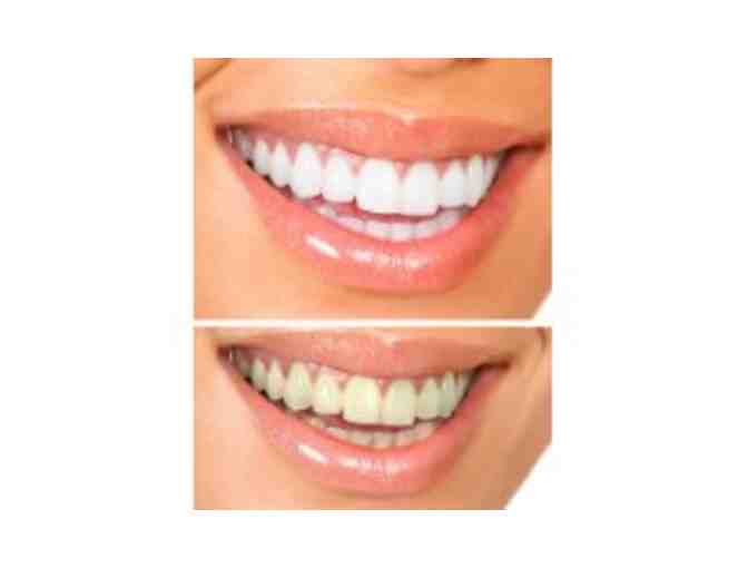Teeth Whitening System From Glenns Bay Dental