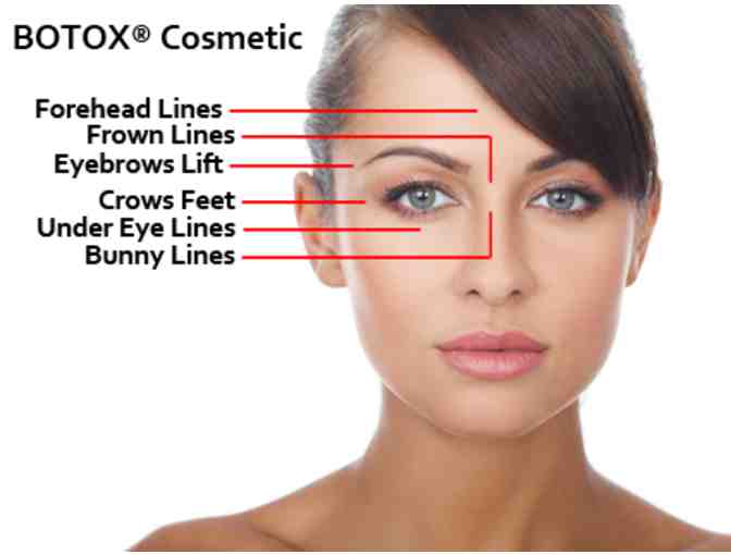 Botox Cosmetic Injection 25 Units by Martin Paukert, MD