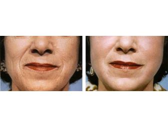 One Free Consultation + One Chemical Peel from CPW Vein & Aesthetic Center