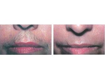 One Free Consultation + One Laser Hair Removal Treatment from CPW Vein & Aesthetic Center