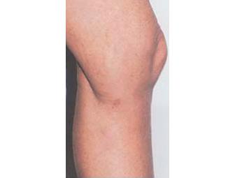 One Free Consultation + One Spider/Varicose Vein Treatment - CPW Vein & Aesthetic Center