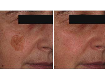 One Free Consultation + One IPL (photofacial) Treatment from CPW Vein & Aesthetic Center