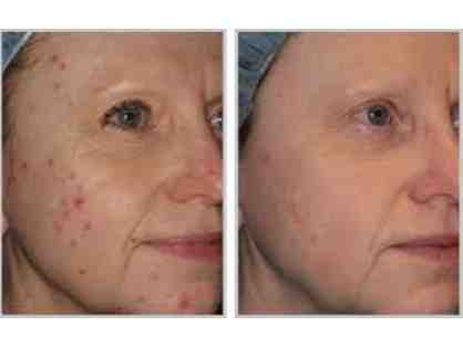 2 BBL Forever Clear Acne Treatments