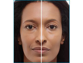 Chemical Peel and Treatment with Fraxel Dual