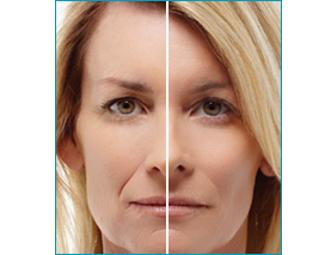 Chemical Peel and Treatment with Fraxel Dual