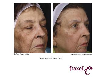 Chemical Peel and Treatment with Fraxel Dual
