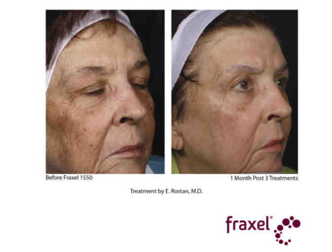 Fraxel Dual Treatment and Botox
