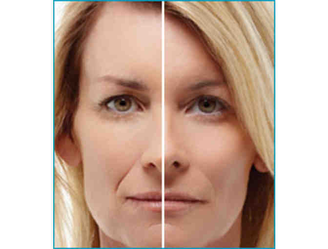 Fraxel Dual Treatment and Botox