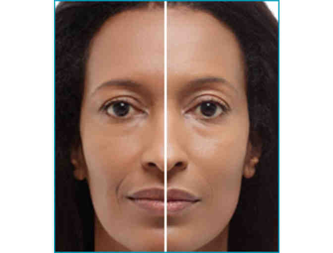 Fraxel Dual Treatment and Botox