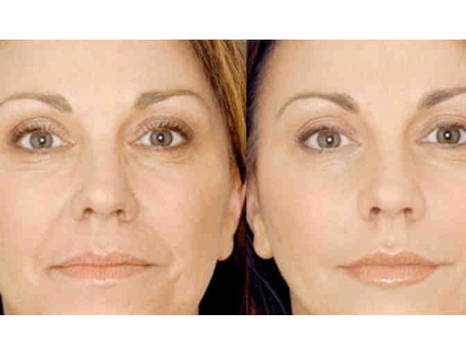 $150 Gift Certificate to Fresh Faces Rx - Facial Rejuvenation!