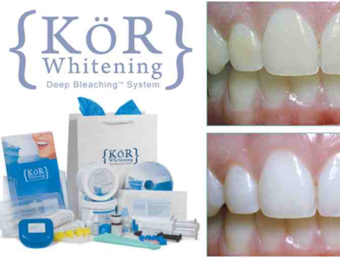 Teeth Whitening - KOR with Bull Mountain Family Dental