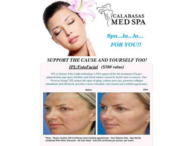 Calabasas Med Spa IPL/FotoFacial ($500 value)