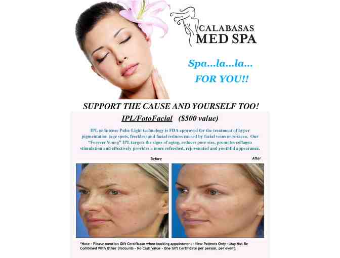Calabasas Med Spa IPL/FotoFacial ($500 value)