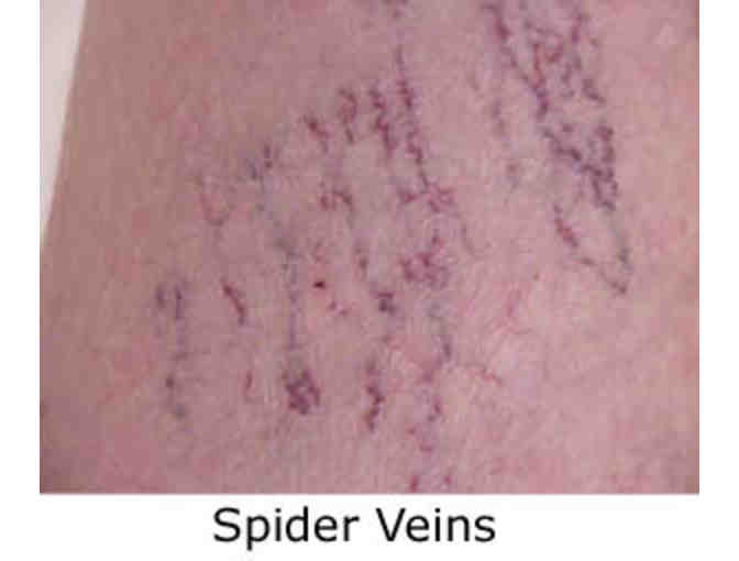 Spider Vein Sclerotherapy Treatment