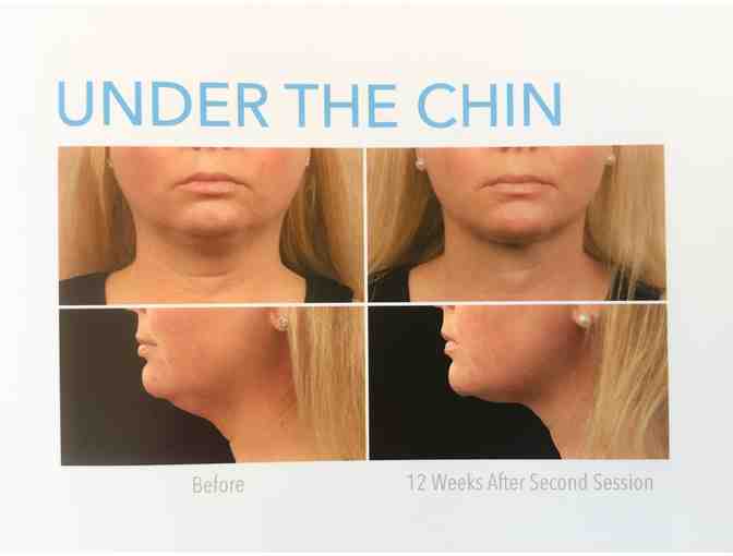 Coolsculpting Non Surgical Fat Melting