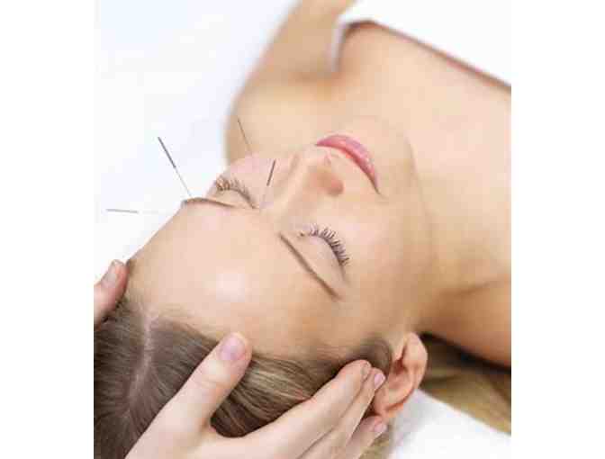 Free Acupuncture and Cupping from Newbury Park Acupuncture