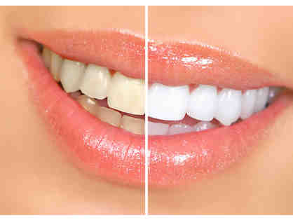 value!$18 CUSTOM teeth whitening by a dentist! less than grocery store whitening strips!