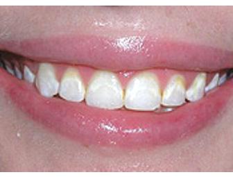 Teeth Bleaching from Dr. Rhoden