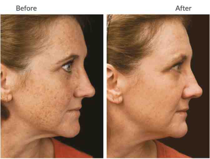IPL laser light treatment to brighten complexion
