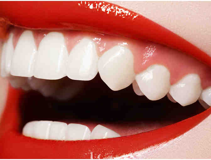 Teeth Whitening- Custom kit
