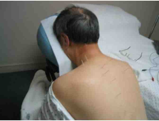 One Session of Acupuncture Treatment