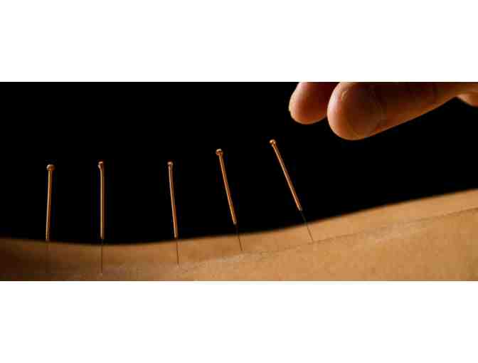 90 Minute Initial Acupuncture from Touchstone Wellness