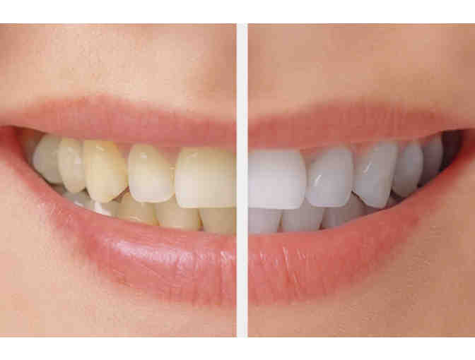 Nannette Benedict, DDS: Tooth Whitening System