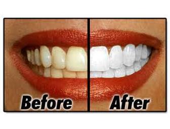 In-Office Whitening by The Dentist At Hopkinton - Hopkinton, MA