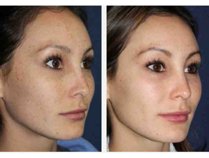 $200 Mommy Makeover Gift Certificate for Beverly Hills Cosmetic & Laser Center (1) - Photo 5