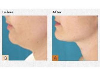 Dr. Roche - Revolutionary Zerona Laser Attacks Fat Cells - Interested?