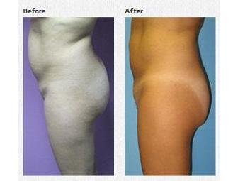 Dr. Roche - Revolutionary Zerona Laser Attacks Fat Cells - Interested?