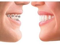Full Set of Orthodontics from Dr. Scotese