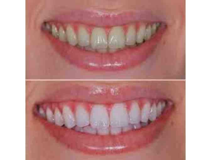 Ideal Dental - Teeth whitening treatment