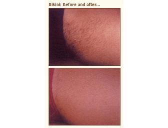 Laser Hair Removal - Alternative Health Associates (Alexandria, VA)