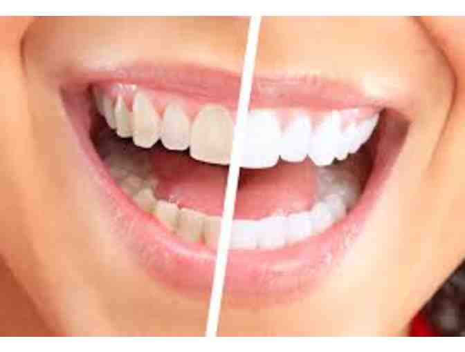Teeth Bleaching -- In Office and Take Home Trays -- Dr. Michael Reich, DDS