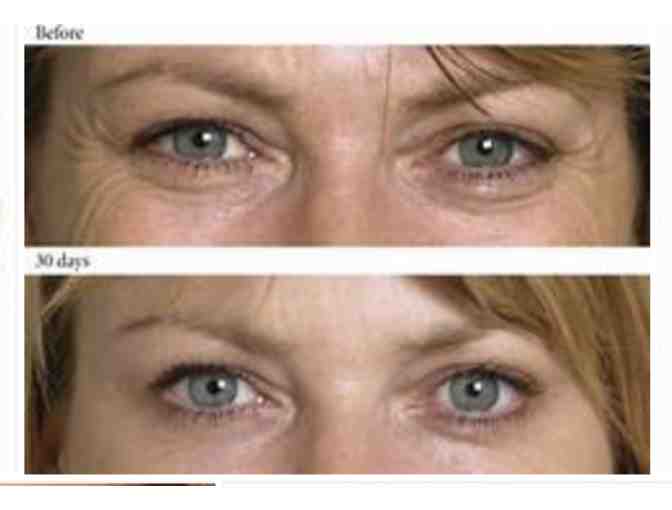 Botox Treatment by Dr. Lisa Wyatt