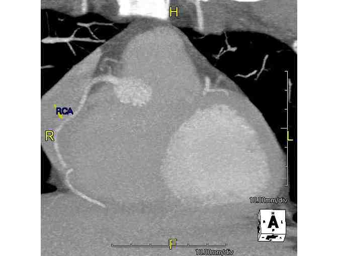 West Valley Imaging: CT Coronary Angiogram