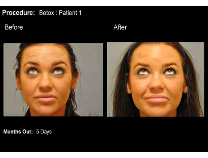 Signature Plastic Surgery: $100 Gift Certificate to use towards Botox or Xeomin