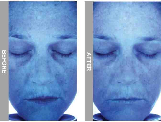 SkinFuzion: One Hydrafacial